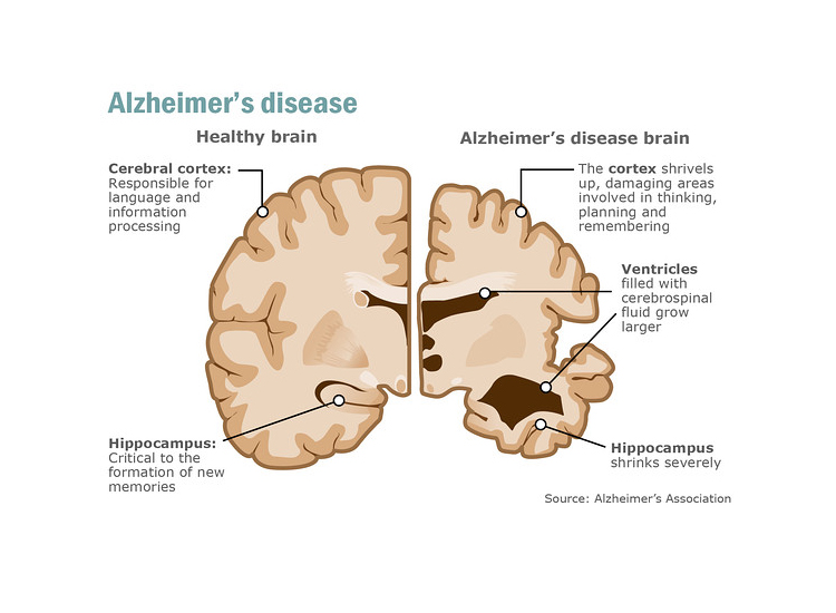 Alzheimer's Disease Graphic Michigan Medicine